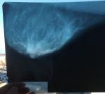 Маммография расшифровка фото 2