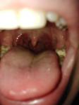 Болит горло и пупырышки фото 2
