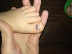 Ушиб ногтя у ребенка фото 1