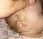 Высыпания на щеках новорожденной фото 1