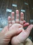 Облазет кожа на пальцах у ребенка фото 3