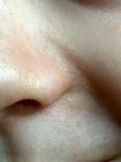 Высыпания у ребенка на крыльях носа и вокруг рта фото 3