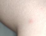 Высыпания на теле по типу комар иных укусов фото 1