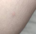 Высыпания на теле по типу комар иных укусов фото 2