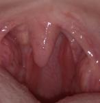 Подвижная шишка в горле возле возле небного язычка фото 4