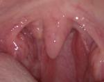 Подвижная шишка в горле возле возле небного язычка фото 3