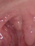 Подвижная шишка в горле возле возле небного язычка фото 2