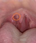 Подвижная шишка в горле возле возле небного язычка фото 1