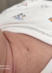 Подозрение на свищ у новорожденного на груди фото 1