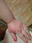 Сыпь, шелушение кожи рук у ребенка фото 2