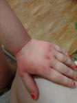 Сыпь, шелушение кожи рук у ребенка фото 1