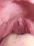 Болит горло, возможно тонзиллит, одна сторона фото 3