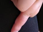 У девочки 8 лет на пальце трескается и воспаляется кожа фото 2