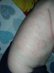 Аллергия или атопический дерматит фото 3