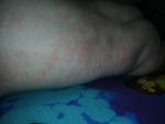 Аллергия или атопический дерматит фото 2