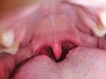 Ком в горле, увеличены миндалины фото 1