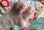 Воспаление пальца и ногтя на ноге фото 1