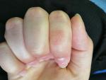 Раздражение на пальцах рук фото 1