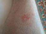 Появилось красное пятно на ноге, с точками фото 1