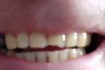 Скол переднего зуба фото 1
