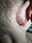 Ранки за ухом у ребенка 7 лет фото 2
