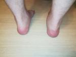 Воспаление суставов руки, ноги фото 3