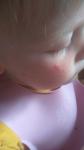 Сыпь на щеках у ребёнка фото 1