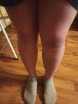 Бурсит коленного сустава фото 2
