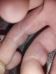 Рубцы на пальчиках после ожога фото 2