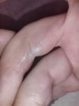 Рубцы на пальчиках после ожога фото 1