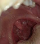 Красное горло, увеличенные миндалины, пятна не нёбе фото 1