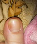 Пятна на большом пальце ноги фото 1