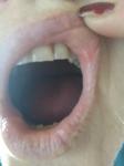 Язва на внутренней стороне губы фото 2