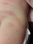 Аллергия у ребенка 1.5 года фото 3