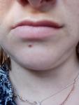 Пигментация вокруг губ, проблемная кожа фото 5