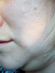 Пигментация вокруг губ, проблемная кожа фото 4