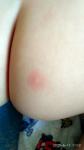 Аллергия, прыщи похожие на укусы комаров уже 4 месяца фото 2
