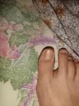 Грибок ногтей на большом пальце ноги фото 3