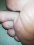 Белая точка на ступней, у пальцев фото 1