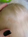 Красное пятно на голове у ребёнка фото 1