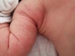 Сыпь новорождённого фото 1
