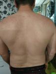 Красная сыпь на спине и груди фото 5