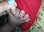 Зудящие прыщи на пальцах у ребенка фото 3