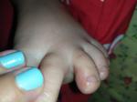 Зудящие прыщи на пальцах у ребенка фото 5