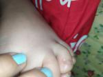 Зудящие прыщи на пальцах у ребенка фото 4