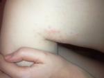Сыпь на сбоку от колена при беременности фото 2