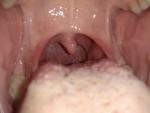 Инфекция в горле фото 1
