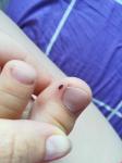 Чёрное пятно на большом пальце ноги фото 1