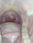 Воспаление в горле фото 2