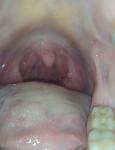 Воспаление в горле фото 1